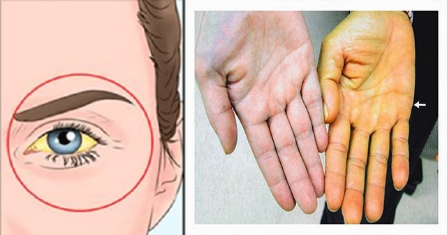 9 Signs Of Liver Damaged That Might Lead To Liver Failure
